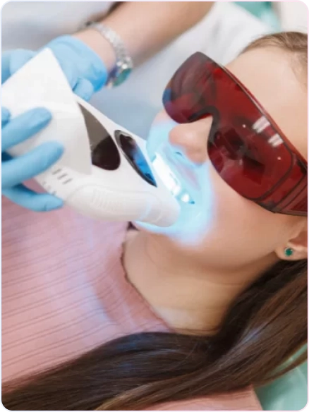 Bleaching Gigi 13 Pemutihan gigi menggunakan alat canggih dengan cahaya LED di Jakarta Selatan