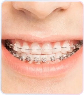 Damon Braces 1 Lihat hasil senyum ceria dengan kawat gigi dari perawatan ortodontik anak di Klinik Dokter Adianti Jakarta Selatan. Kami membantu si kecil percaya diri dengan gigi yang sehat dan teratur.
