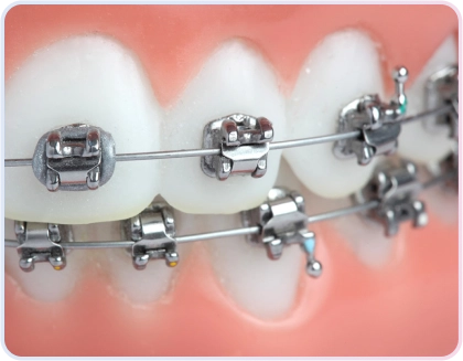 Damon Braces 2 Detail kawat gigi konvensional pada perawatan ortodontik anak di Klinik Dokter Adianti Jakarta Selatan