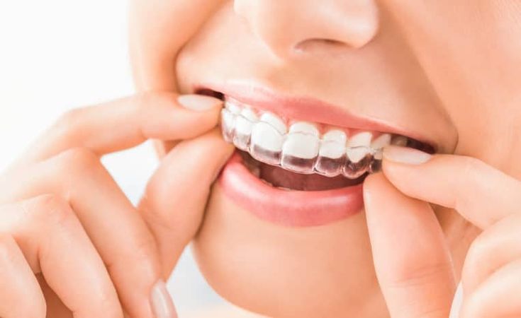 Mengenal Aligner Gigi dan Behel Gigi: Simak Definisi, Cara Kerja, dan Perbedaaanya! 3 Aligner gigi