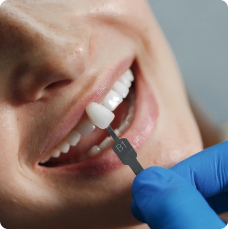 Bleaching Gigi 5 Dokter gigi menggunakan panduan warna untuk pemilihan veneer gigi di Jakarta Selatan