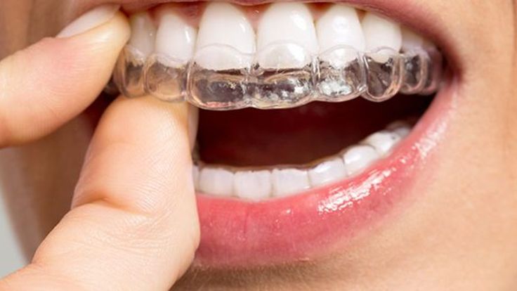 Invisalign untuk Gigi Tonggos: Solusi Memperbaiki dan Merapikan Gigi 1 invisalign untuk gigi tonggos