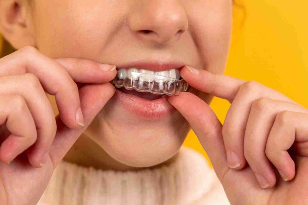 Mengetahui Clear Aligners OneSmile: Solusi Gigi Rapi Tanpa Behel 1 sebuah clear aligners yang terpasang di gigi