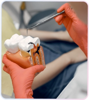 Tangan dokter gigi bersarung tangan merah sedang menjelaskan model gigi berlubang besar menggunakan instrumen dental, mengilustrasikan kebutuhan tambal gigi.