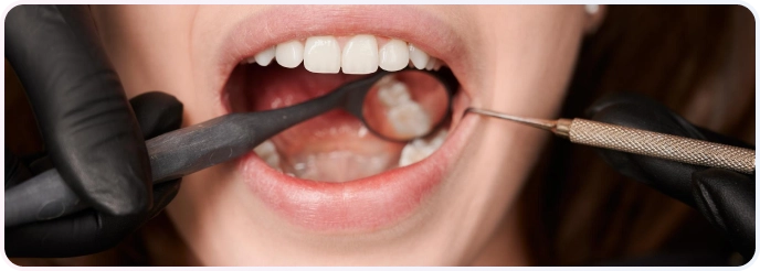 Penambalan Gigi 6 Close-up gigi pasien yang bersih dan putih sedang diperiksa menggunakan cermin dental dan probe oleh dokter gigi bersarung tangan hitam.