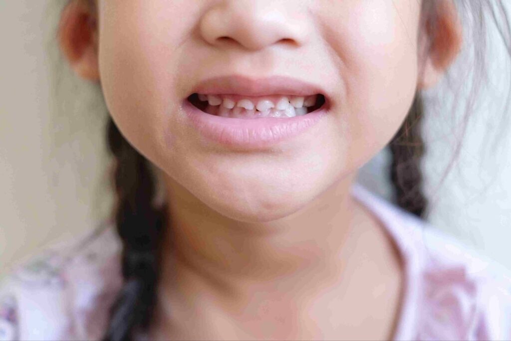 Mitos dan Fakta Behel Gigi Anak yang Wajib Diketahui Orang Tua 1 Behel Gigi Anak