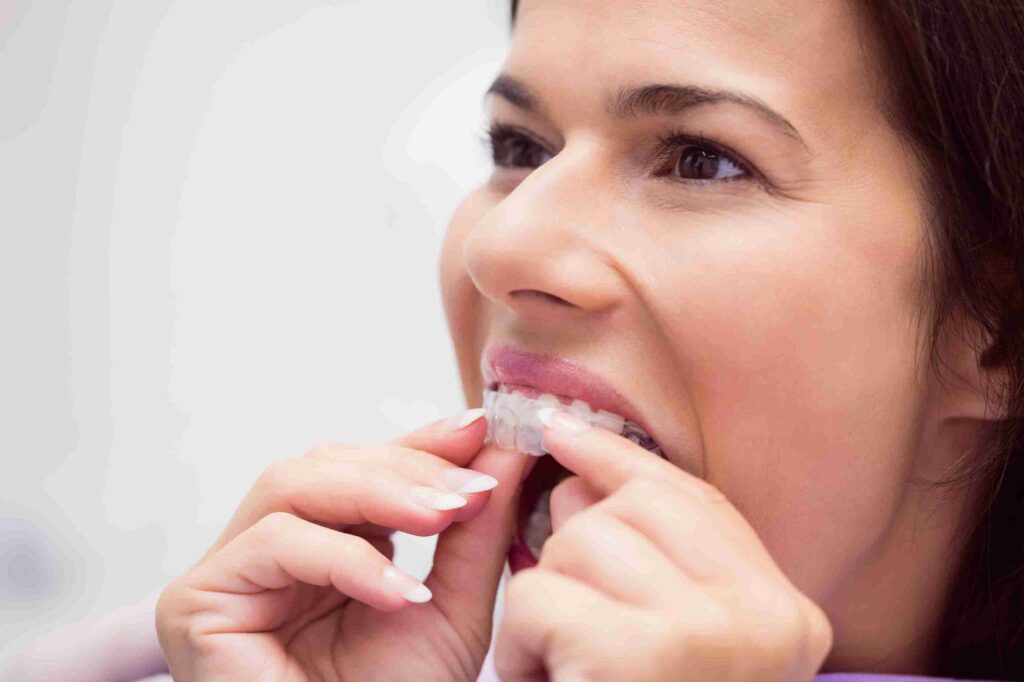 Sudah Lepas Behel Jangan Lupakan Retainer Gigi!